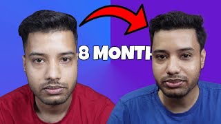 8 month Update  Hair Transplant [upl. by Skees]