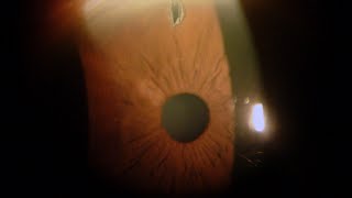 Iridotomia Laser per Glaucoma  Studi Oculistici Abbondanza [upl. by Manuela]