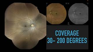 Fundus Photography Essentials in Glaucoma Practice Dr Sathyan Parthasarathi [upl. by Atsirtal901]