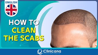 How to clean the scabs after 11 days from the hair transplant operation [upl. by Amsed]