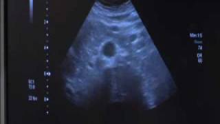 Abdominal Aorta Ultrasound  Conemaugh Physician Group Vascular Services [upl. by Suedama]