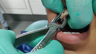 Painless and Easiest method for tooth extraction [upl. by Deelaw]