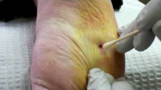 Surgical Plantar Wart Removal [upl. by Ylhsa745]