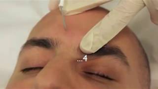 Sebaceous Hyperplasia Treatment using Electrodessication [upl. by Haywood]