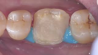 Root canal treatment followed by preliminary overlay preparation A detailed video [upl. by Noirad]