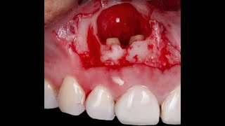 How to drain a dental abscessShort video Dr Shihab Romeed [upl. by Aneelak]