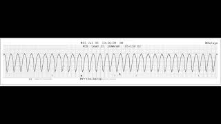 Shockable rhythms [upl. by Elicec]