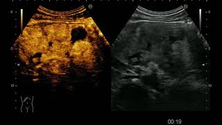 Advanced pancreatic adenocarcinoma contrast enhanced ultrasound and endoscopic ultrasound [upl. by Sigfrid]