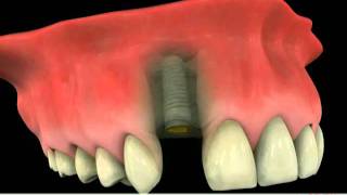 Implant versus Dental Bridge  Which Is More Reliable [upl. by Roobbie]