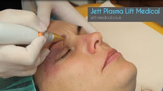 Blepharopolasty with the Jett Medical Plasma device [upl. by Yenffit]