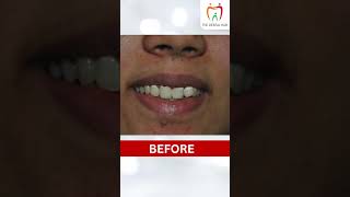 Transforming Smile With Direct Partial Veneers  Smile Makeover  Dental Transformation [upl. by Yahsat]