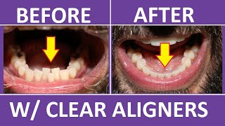 Invisalign Overbite Correction  6 Month UPDATE with before and after pics [upl. by Duaner456]