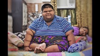 Worlds Heaviest Teenager Weighing 237Kgs  Loses Weight [upl. by Eesdnil]