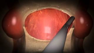 Updated Video Available Endoscopic Endonasal Pituitary and Skull Base Surgery [upl. by Atilam636]