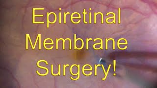 Epiretinal membrane surgery Vitrectomy with ERM Macular Pucker peeling  Dr Simon Chen [upl. by Dido]