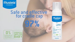 How To Care For Cradle Cap [upl. by Abie133]