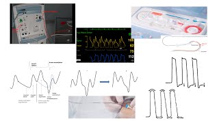 Balloon pump hemodynamics troubleshooting technical tips Elias Hanna [upl. by Norry]