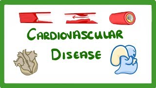 GCSE Biology  Why Do We Get Heart Disease and How to Treat It  Cardiovascular Disease CVD 47 [upl. by Neira]