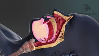 Treating snoring in sleep medical animation [upl. by Threlkeld]