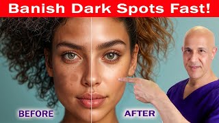 See a Change in 24 Days Banish Dark Spots Hyperpigmentation Melasma amp Acne Scars Dr Mandell [upl. by Claudie]