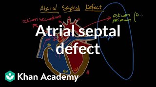 Atrial septal defect  Circulatory System and Disease  NCLEXRN  Khan Academy [upl. by Anen]