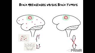 Brain Metastases versus Brain Tumors [upl. by Aillimac706]