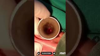 Lt Modified Butterfly Tympanoplasty using Tragal Cartilage [upl. by Buine]