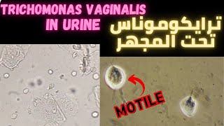 ترايكوموناس في عينة فحص البول Trichomonas vaginalis in urine sample [upl. by Asilav]