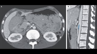 Arteria mesenterica superior Syndrom [upl. by Ytirehc]