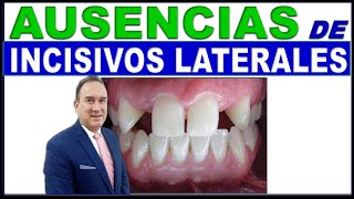 AUSENCIA CONGENITA 𝘿𝙀 INCISIVO LATERALES SUPERIORES [upl. by Leitman]