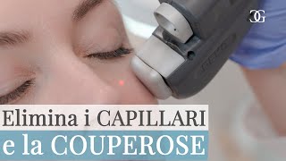 Come eliminare i CAPILLARI e la COUPEROSE con il LASER  Drssa Beatrice GIORGINI [upl. by Leotie]