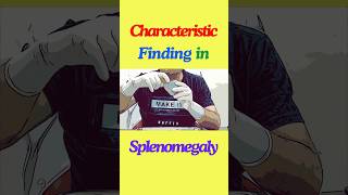 What is the characteristic finding in splenomegaly Enlarged spleen shorts spleen splenomegaly [upl. by Maite]