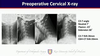 Cervical Kyphosis after Laminoplasty for Degenerative Cervical Myelopathy  Masahiro Ozaki MD [upl. by Edrei]