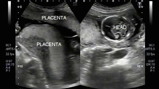 Ultrasound Video showing double placenta in twin pregnancy [upl. by Tammi656]