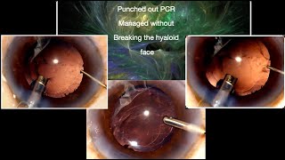 Punched out PCR without hyaloid compromise and implanting a 3 piece IOL  surgical strategy [upl. by Piegari]