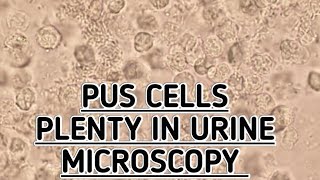 Pus CellsPlenty seen in urine microscopy showing urine tract infectionUTIPyuria seen in urine [upl. by Dee Dee585]