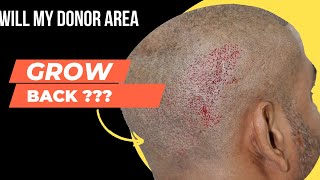 Donor Area Recovery After Hair Transplant  Fue Donor Area In Hair Transplant [upl. by Primaveras]