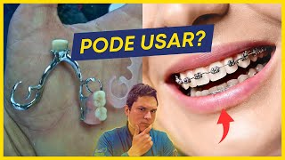 Quem usa prótese pode usar aparelho [upl. by Aizan]