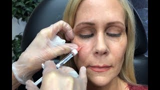 Dermal Filler Under Eyes Tear Trough Restylane and Radiesse [upl. by Nyladgam875]