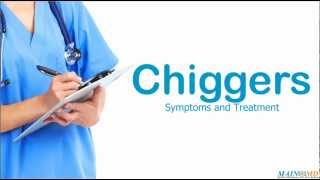 Chiggers Symptoms and Treatment [upl. by Anikahs]