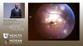 Uveitis Presentations [upl. by Keelia]