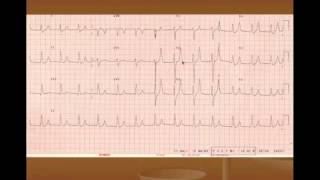 Hyperkalemia Treatment and ECG Changes [upl. by Royden]