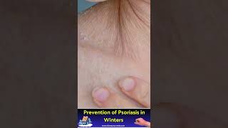 Prevention of Psoriasis in Winters psoriasiscure skincareroutine psoriasis skincare skin [upl. by Acinaj350]