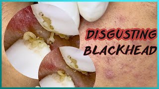 Big Cystic Acne Blackheads Extraction Blackheads amp Milia Whiteheads Removal Pimple Popping [upl. by Onaicram613]