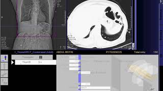 HRCT Scan of Chest full work quot SIEMENSquot [upl. by Grace]