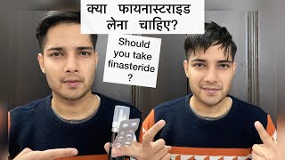 क्या आपको FINASTERIDE लेना चाहिए Finasteride Side effectsHindi Before and After Results Tablet [upl. by Early]