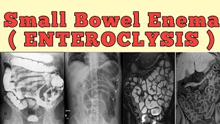 Small bowel enema  Enteroclysis [upl. by Leiba151]