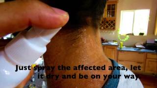 Natural Tinea Versicolor RemedyHaole Rot Spray [upl. by Anelej]