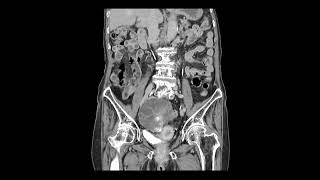 mucinous ovary cystadenoma [upl. by Apps]