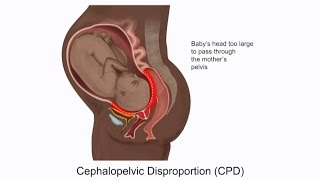 Cephalopelvic Disproportion CPD and Birth Injury [upl. by Tarr]